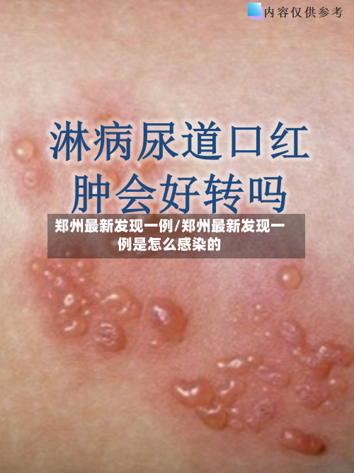 郑州最新发现一例/郑州最新发现一例是怎么感染的
